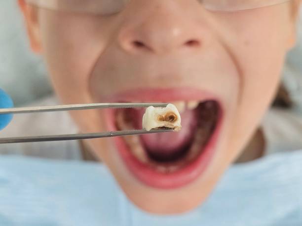 Best Emergency Treatment for Dental Infections or Abscesses in Glenn Heights, TX